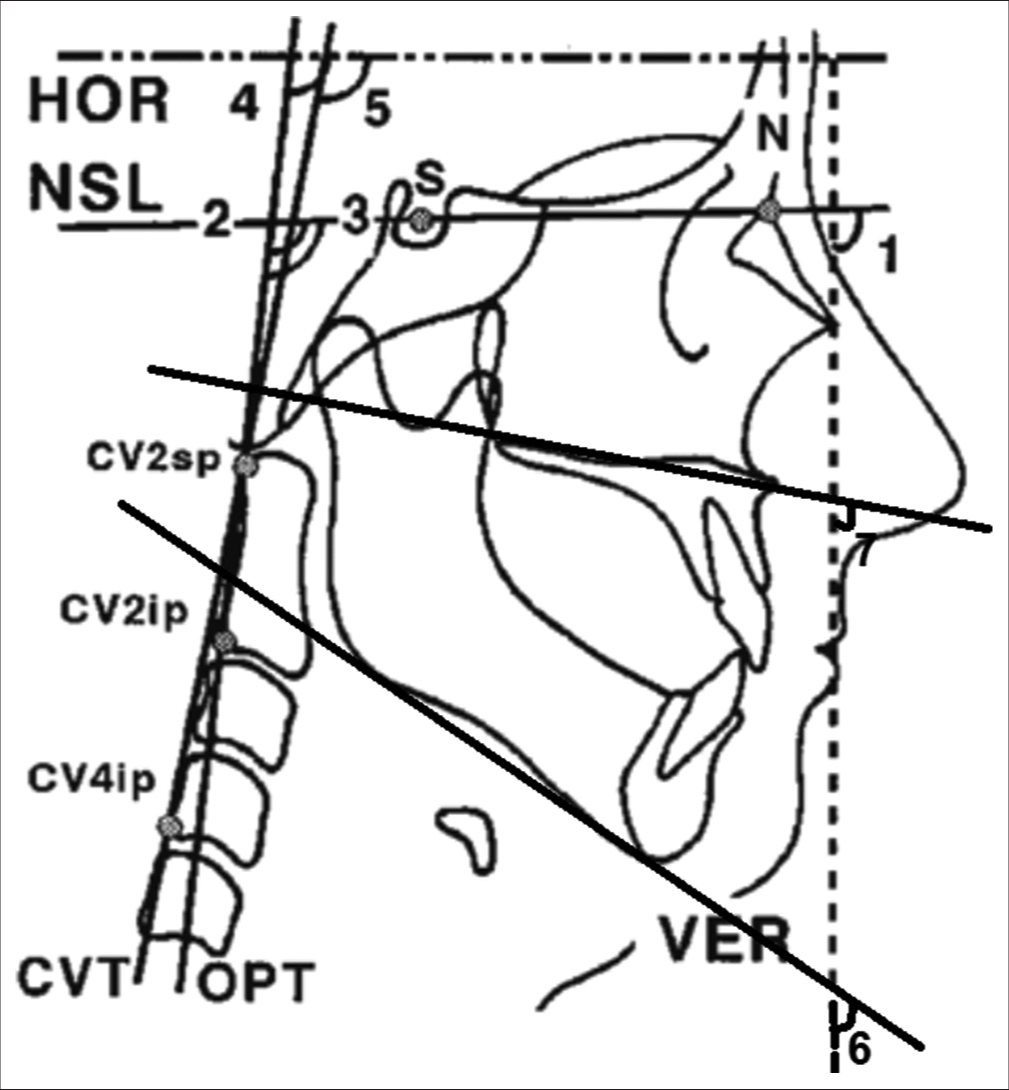 A sample tracing of angles determining the natural head and neck position. HOR: Horizontal, CVT: Cervical vertebra tangent, OPT: Odontoid process tangent, VER: Vertical, CV2sp-Second cervical vertebra superior point, CV2ip: Second cervical vertebra inferior point, CV24ip: 4th cervical vertebra inferior point, SNL: Sella Nasion line, N: Nasion, S: Sella, (1) SNL/VER angle, (2) SNL/OPT angle, (3) SNL/CVT angle, (4) OPT/HOR angle, (5) CVT/HOR angle, (6) ML/VER angle, (7) NL/VER angle.