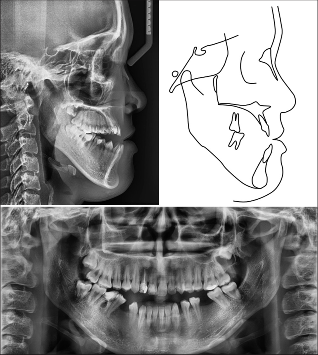 Pre-treatment radiographs and tracing.