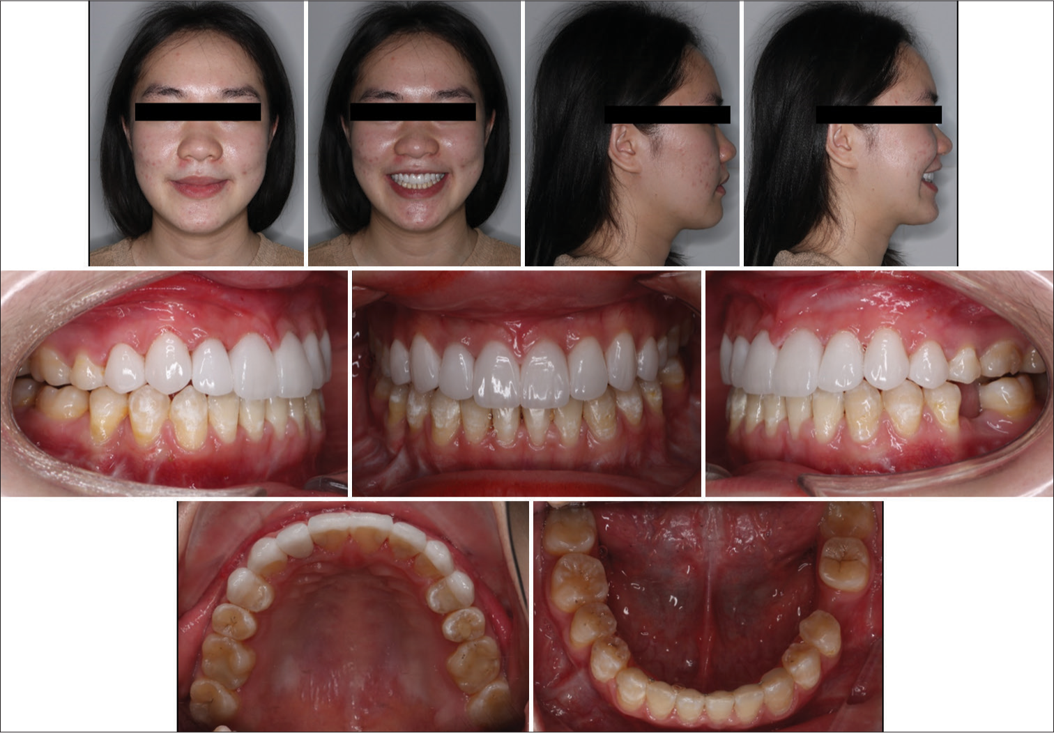 Six-month follow-up photographs. Upper anterior teeth were restored with porcelain laminate veneer.