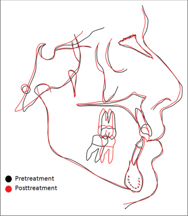 Superimposition between the pre- and post-treatment cephalometric tracings.