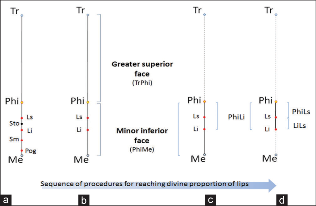 The line TrMe segmented into (a) The golden section at point Phi, and the distances (b) PhiMe, (c) PhiLi, and (d) PhiLs and LiLs were defined. TrMe: Trichion menton, PhiMe: Distance between point Phi and Me, PhiLi: Distance between point Phi and Li, PhiLs: Distance between point Phi and Ls, LiLs: Distance between point Li and Ls.