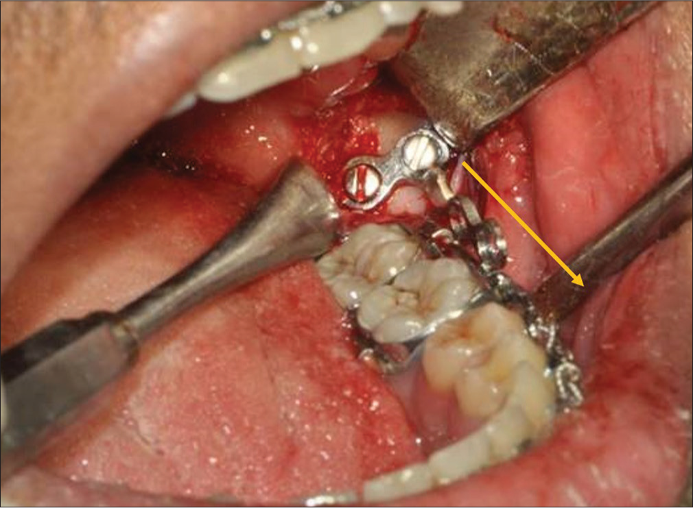 Miniplate in the retromolar site surgically inserted to provide orthodontic anchorage. Note the point of force attachment is more along the line of occlusion as denoted by the yellow arrow leading to lesser side effects.