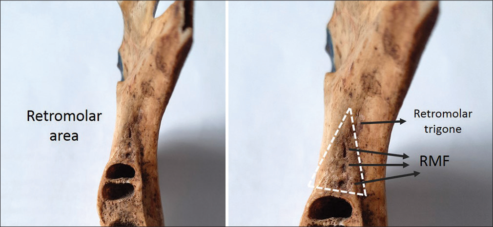 Anatomy of retromolar area showing the retromolar trigone and retromolar foramen (black arrows). RMF: Retromolar formamen