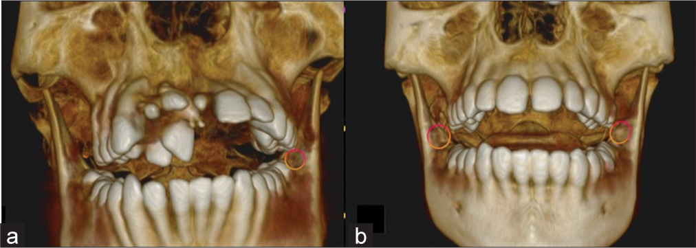 Evaluation of 3D cone-beam computed tomography image showing (a) unilateral and (b) bilateral presence of RMF. (RMF: Retromolar formamen)