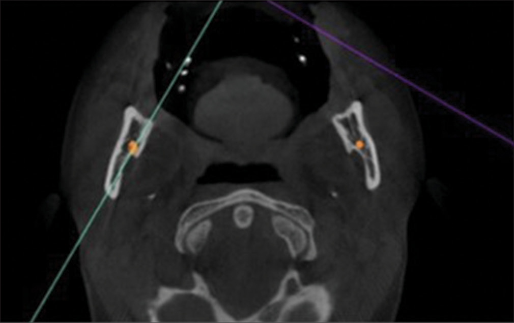 Orientation of cone-beam computed tomography image in the coronal view and marking of the RMF using nerve tool. (RMF: Retromolar formamen)