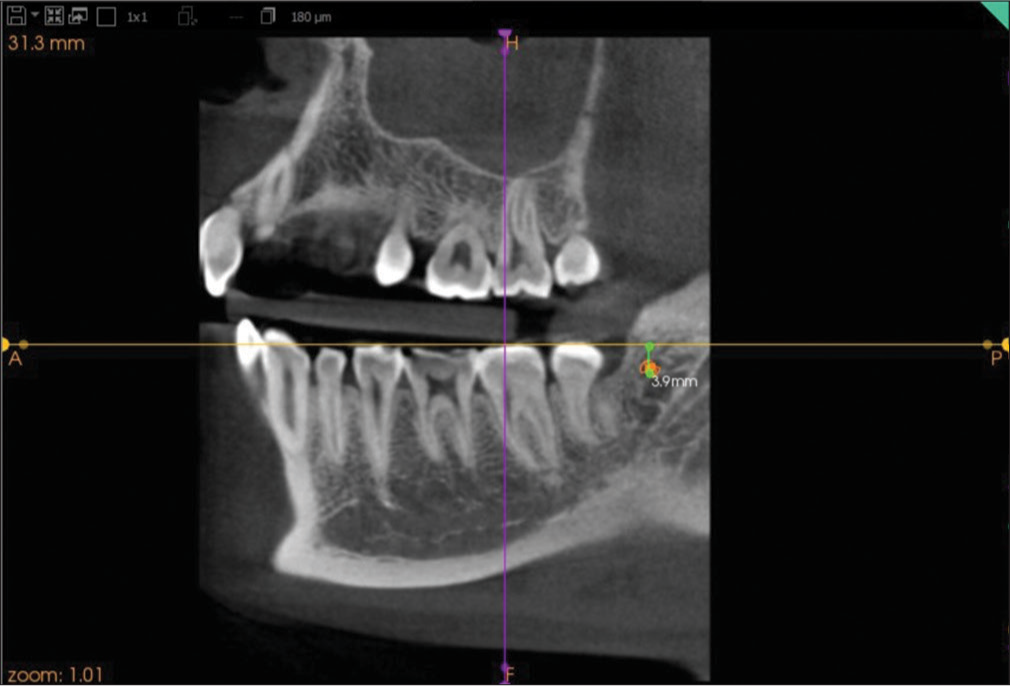 Linear distance of retromolar foramen from the occlusal plane.