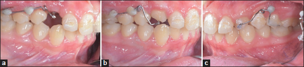 (a-c) Sectional wire using 0.017 × 0.025 Titanium molybdenum archwire (TMA).