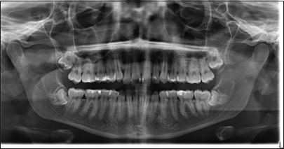 Final panoramic X-ray.