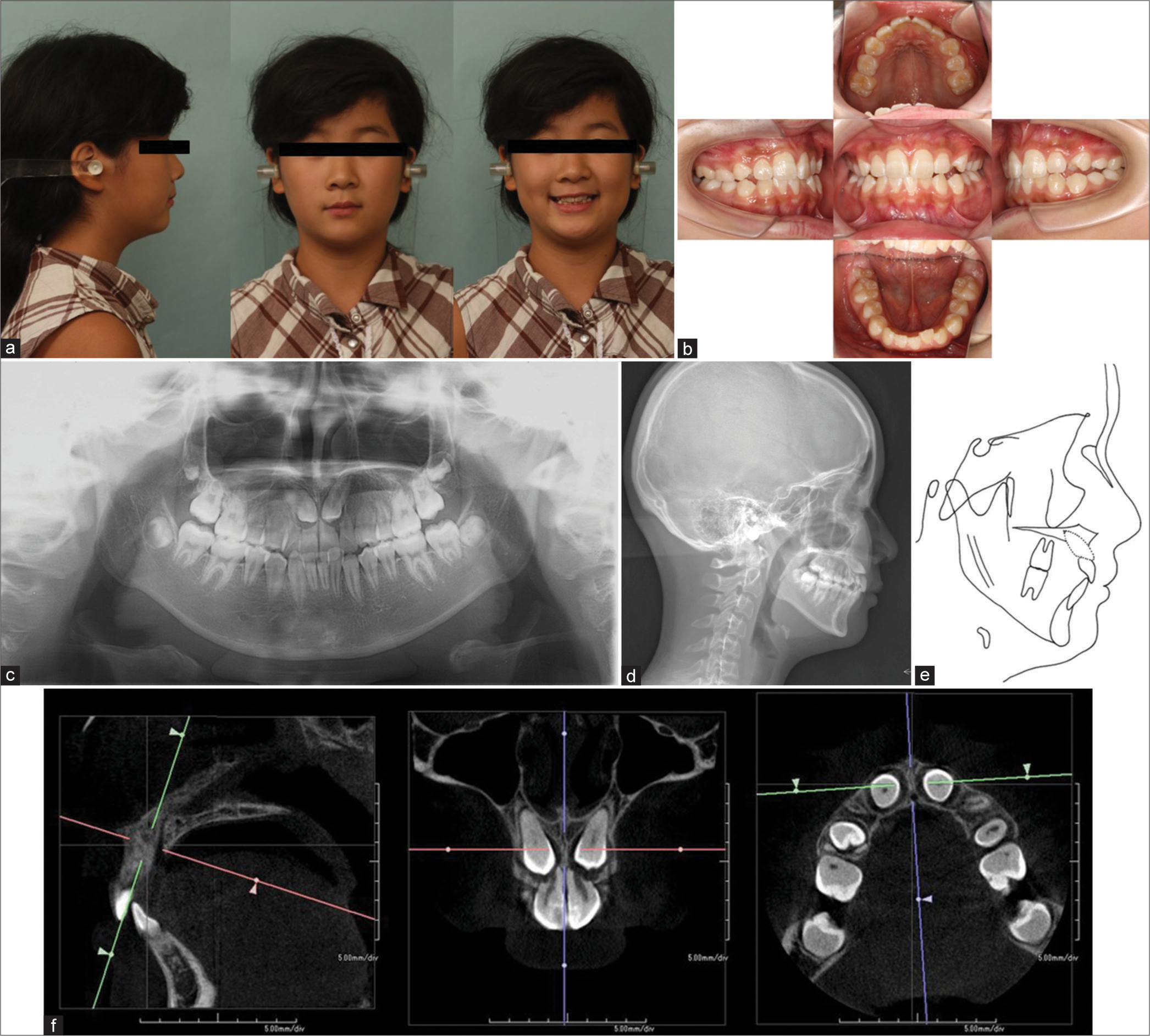 Pre-treatment (a) Pre-treatment facial photographs. (b) Pre-treatment intraoral photographs. (c) Pre-treatment panoramic radiographs. (d) Pre-treatment cephalometric radiographs. (e) Pre-treatment cephalometric tracing. (f) Pre-treatment cone beam computed tomography images.