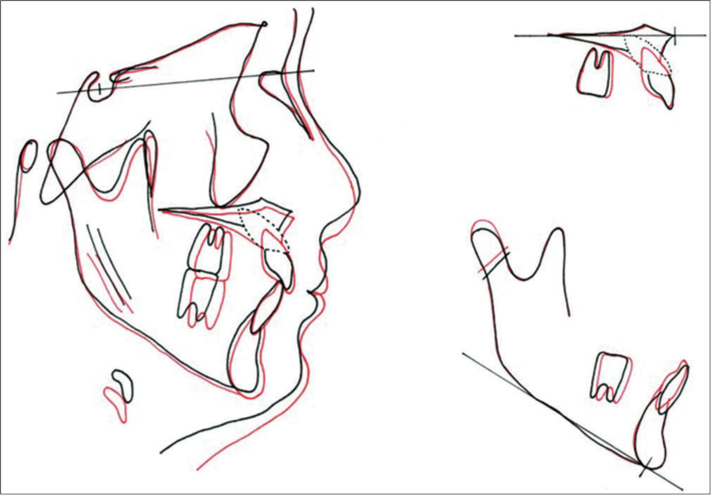 Superimpositions, pre-treatment cephalometric tracing (black line), post-treatment cephalometric tracing (red line).