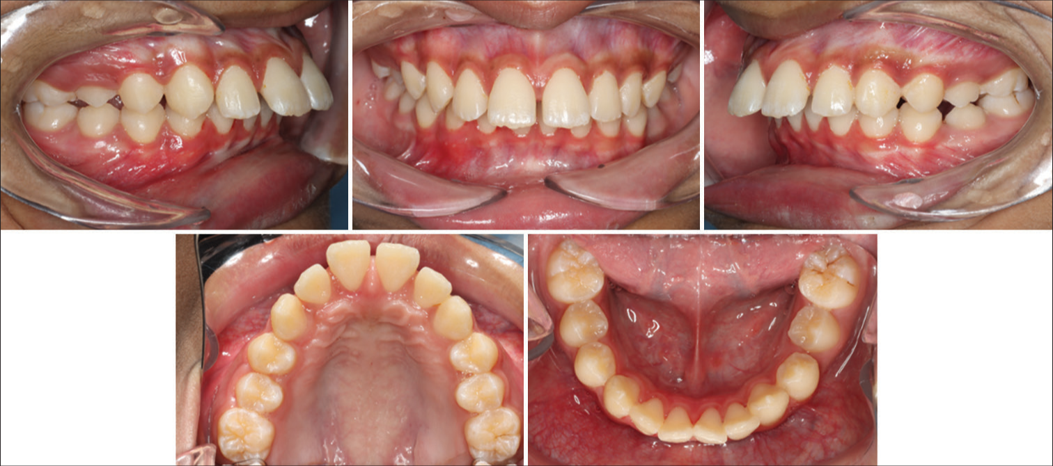 Pre-treatment intraoral photographs.