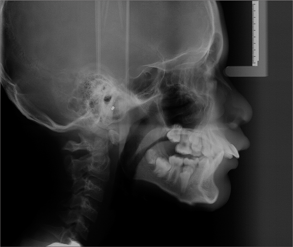 Pre-treatment lateral cephalogram.