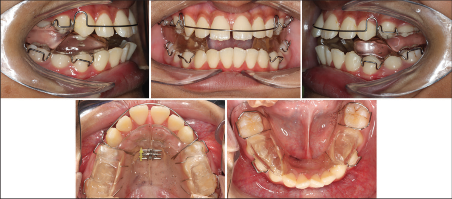 Modified Clark Twin Block appliance photographs.