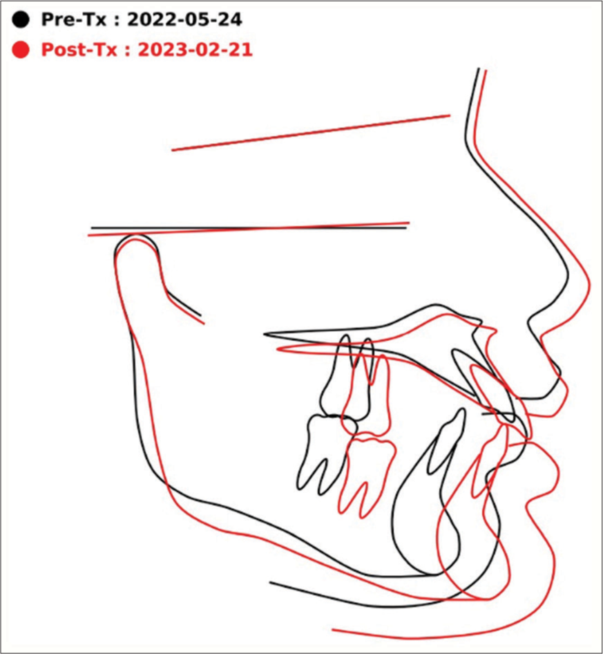 Overall superimposition. Tx: Treatment