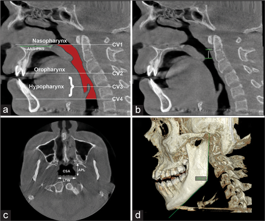 Parameters for pharyngeal airway analysis (a) Determine the reference planes sagitally, as the distance from anterior nasal spine to posterior nasal spine as CV1 plane. Cv1 to CV2 as Oropharynx and CV2 to Cv4 as Hypopharynx; (b) Constricted distance; (c) largest transverse width and anteroposterior length determines the anatomic characteristics of the upper airway and cross-section area on axial plane. Largest transverse width, anteroposterior length; (d) Gonial angle of mandible.