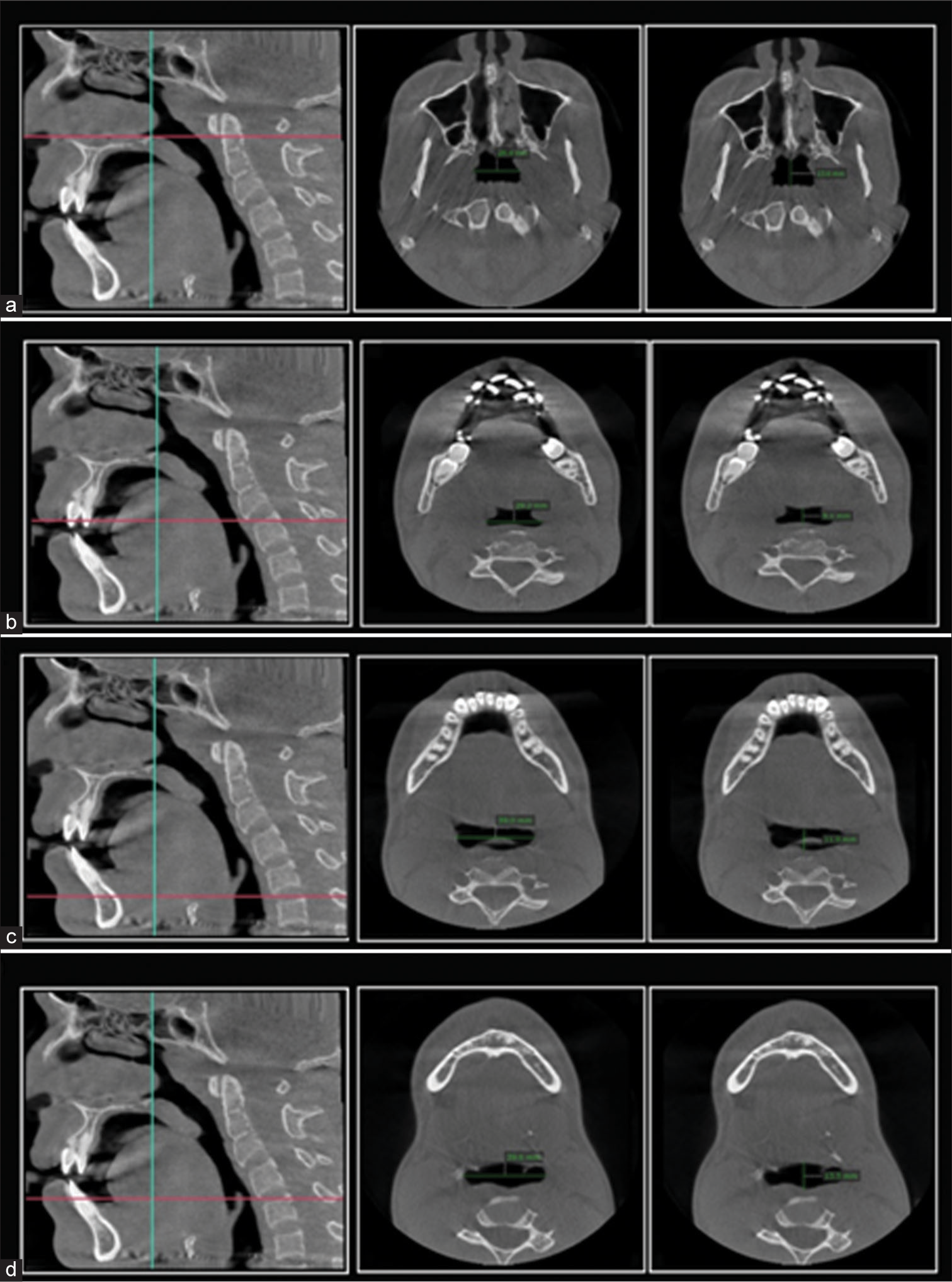 Parameters for pharyngeal airway analysis at the level of cervical vertebrae and epiglottis (a) interspace at C1, interspace at C1 anterioposteriorly, (b) interspace at C2 and interspace at C2 anterioposterioly, (c) interspace at C3 and Interspace at C3 anterioposteriorly, (d) Interspace at epiglottis and Interspace at epiglottis anterioposteriorly