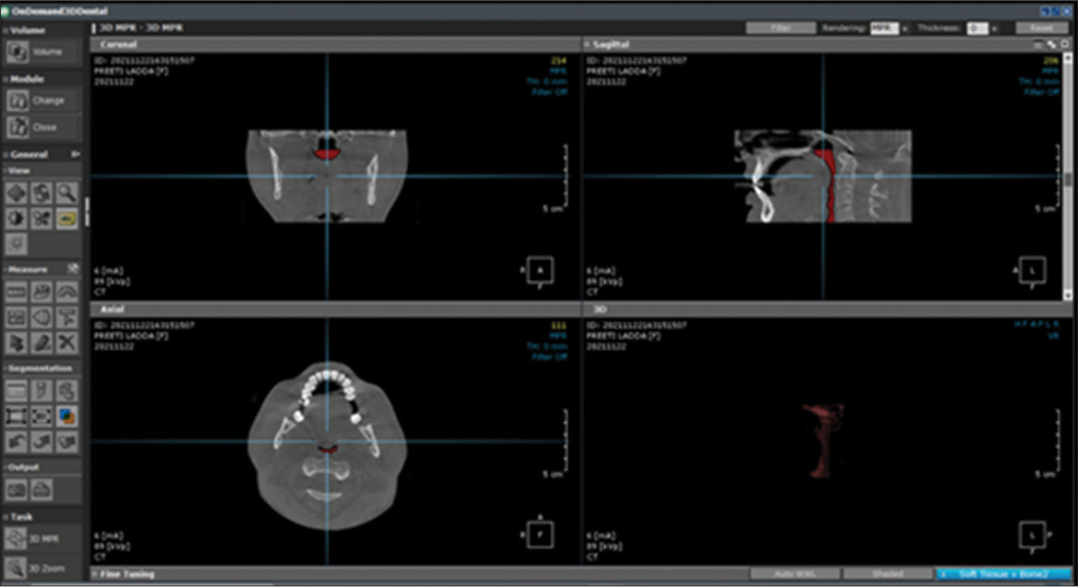 Segmentation of pharyngeal space described in the red text represents the 3D volume of union between the oropharynx and the hypopharynx.