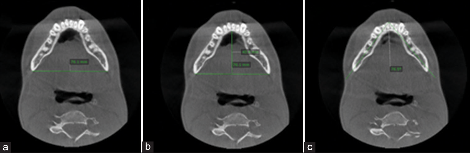 Parameters for mandibular morphology analysis (a) Inter-distance of mandible; (b) anterior-posterior distance of mandible; (c) Transverse angle of mandible.