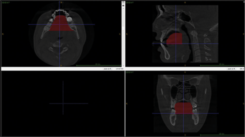 Segmentation of the tongue described in red text represents the 3D volume of tongue.