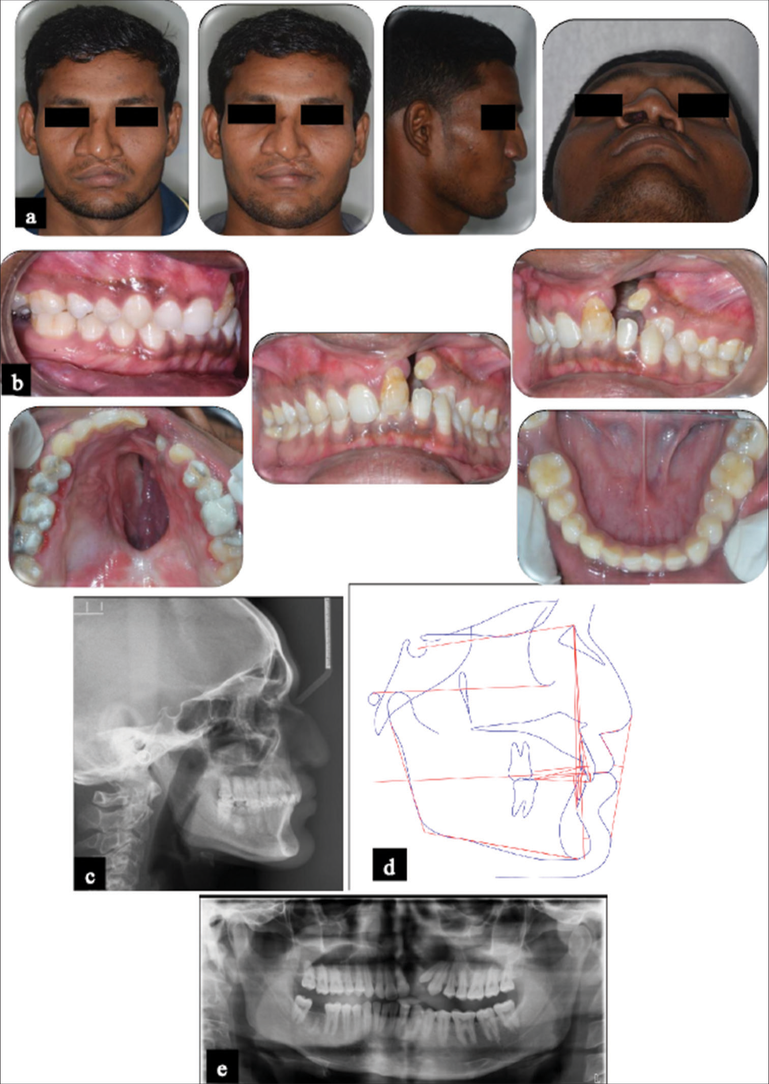 Pre-treatment records. (a) Facial photographs; (b) Intraoral photographs; (c) Lateral cephalogram; (d) Cephalometric tracing; (e) Panoramic radiograph.