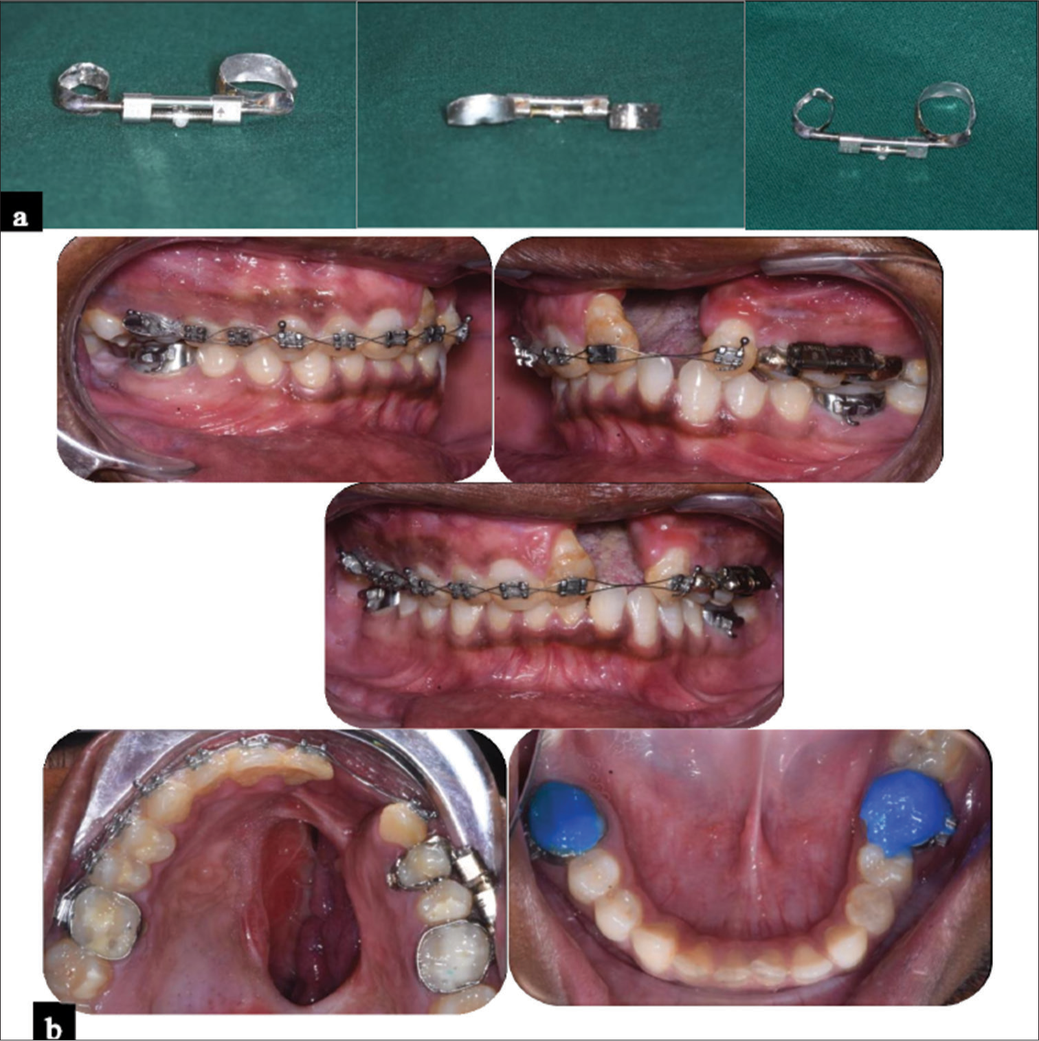 (a) Custom-made internal distractor. (b) Cementation of custom-made internal distractor.