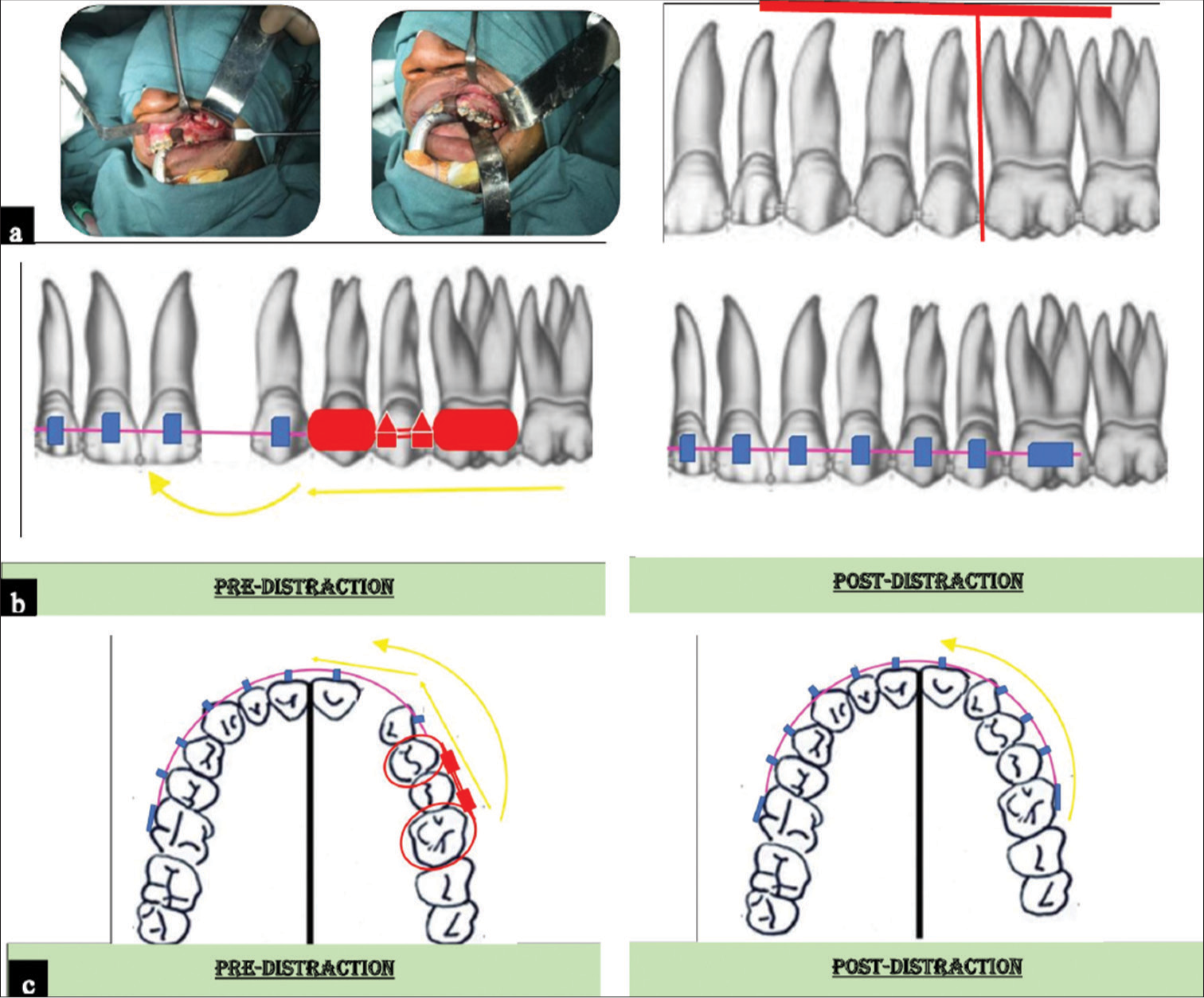 (a) Osteotomy phase; (b) Biomechanics of internal alveolar distractor – Buccal view; (c) Biomechanics of internal alveolar distractor – occlusal view. yellow line indicates the curvilinear direction of movement of the distracted segments