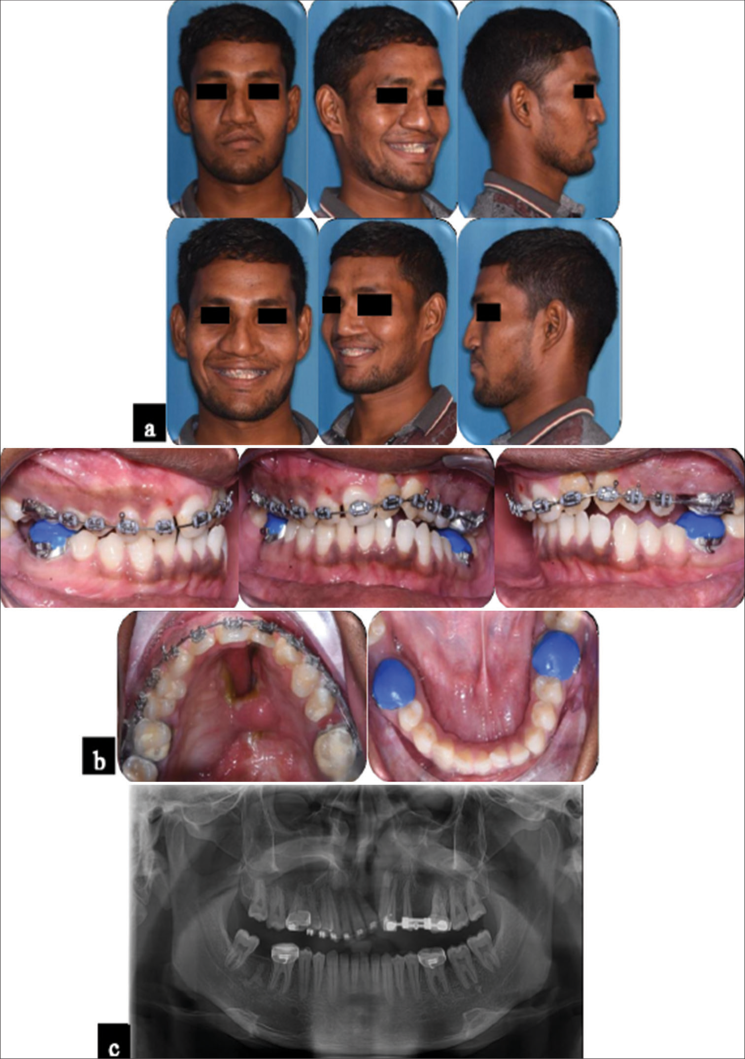 Post-distraction records. (a) Facial photographs; (b) Intraoral photographs; (c) Panoramic radiograph.