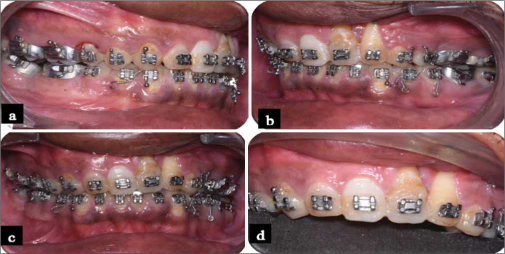 Reshaping of second quadrant incisor, canine, and premolar. (a) Right lateral view, (b) Left lateral view, (c) Frontal view, (d) Close up view of Anterior teeth.