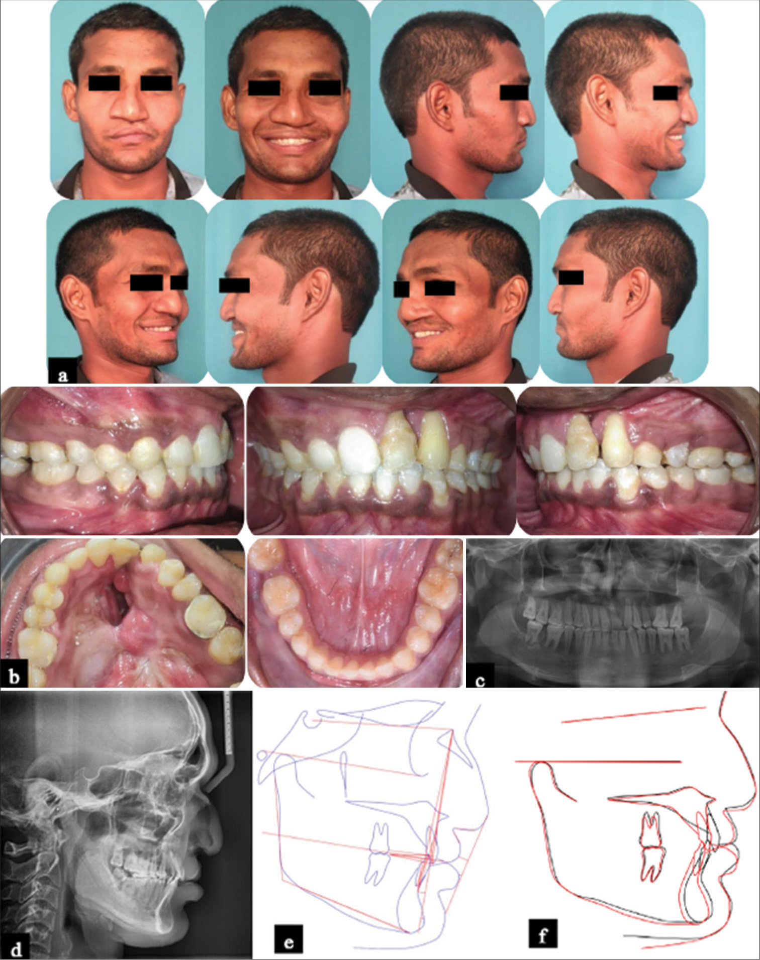 Post-treatment records. (a) Facial photographs; (b) Intraoral photographs; (c) Panoramic radiograph; (d) Lateral cephalogram; (e) Cephalometric tracing; (f) Superimposed cephalometric tracings: Pre-treatment (Black) and post-treatment (Red).