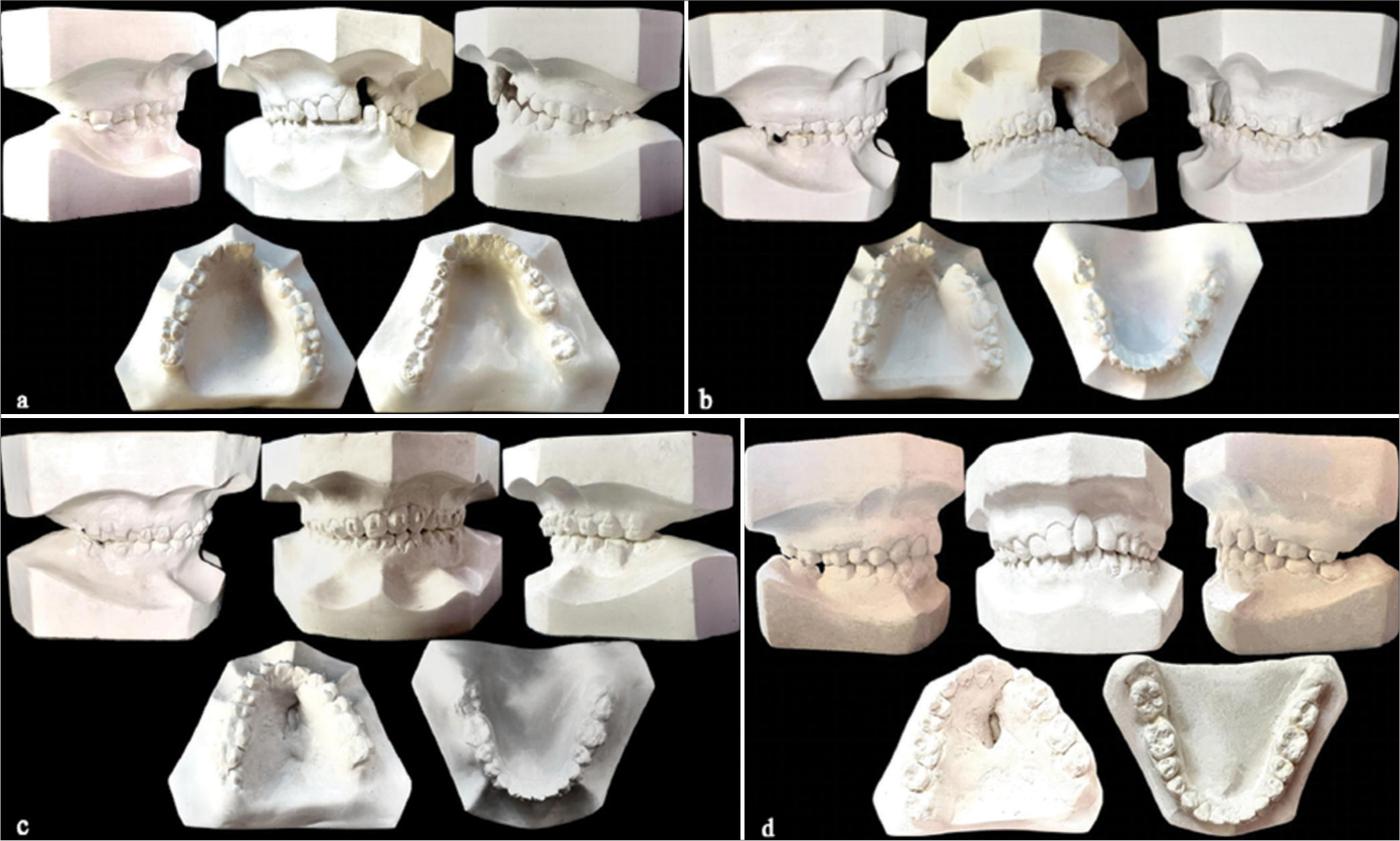 Dental models. (a) Pre-treatment; (b) Pre-distraction; (c) Post-distraction; (d) Post-treatment.