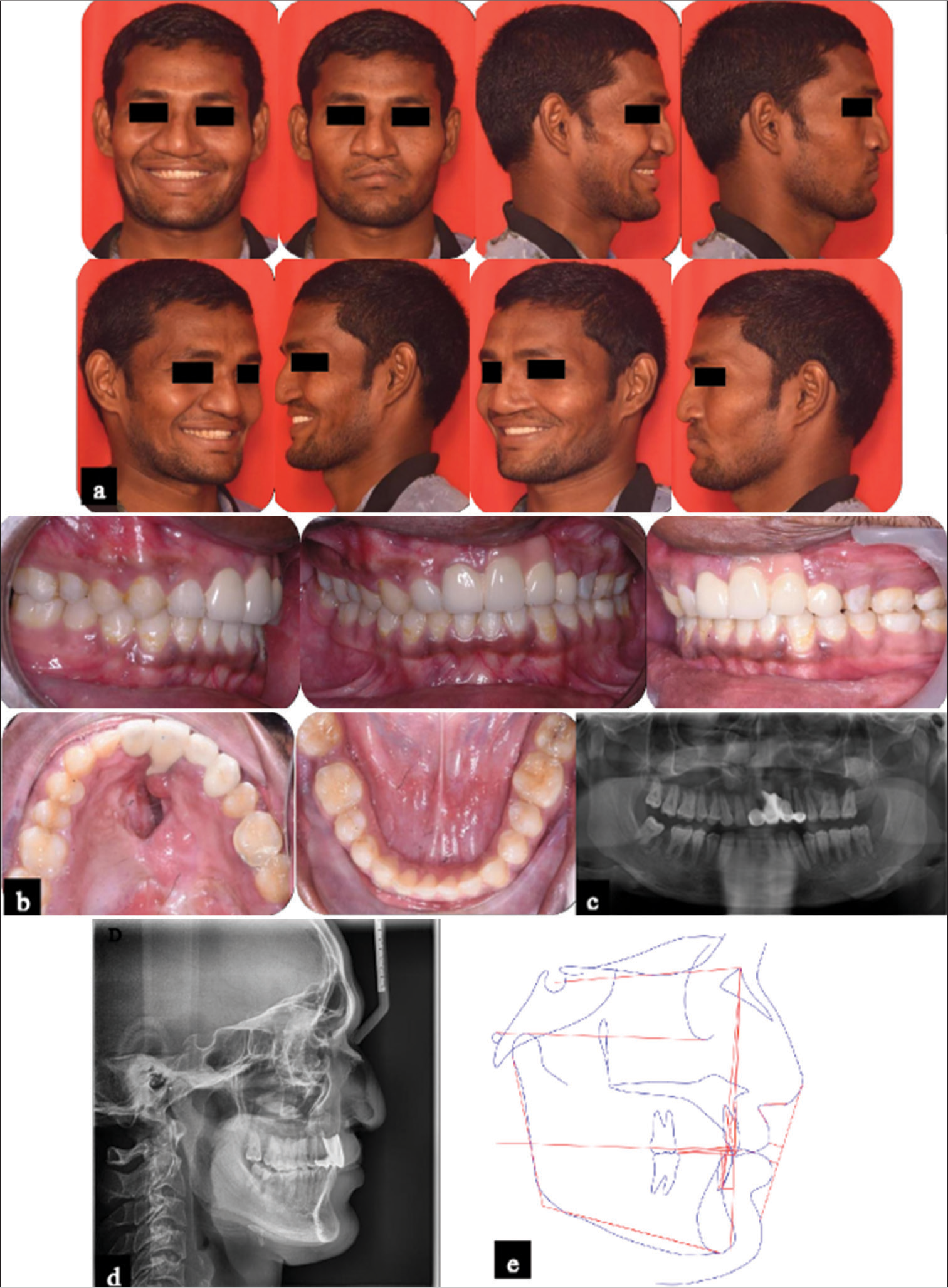 1 year post-treatment records. (a) Facial photographs; (b) Intraoral photographs; (c) Panoramic radiograph; (d) Lateral cephalogram; (e) Cephalometric tracing.