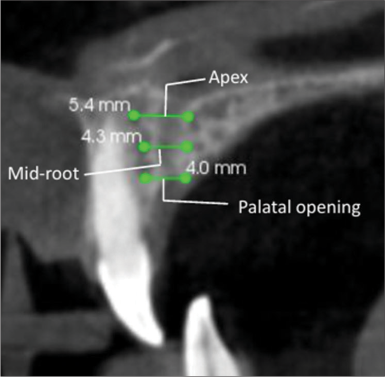 Sagittal plane levels at palatal opening, mid root, and apex.