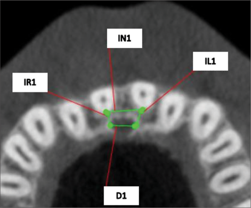 Various measurements done in axial plane. IN: Inter-root distance, IR: Distance between incisive canal to right central incisor, IL: Distance between incisive canal to left central incisor, D: Width of incisive canal.