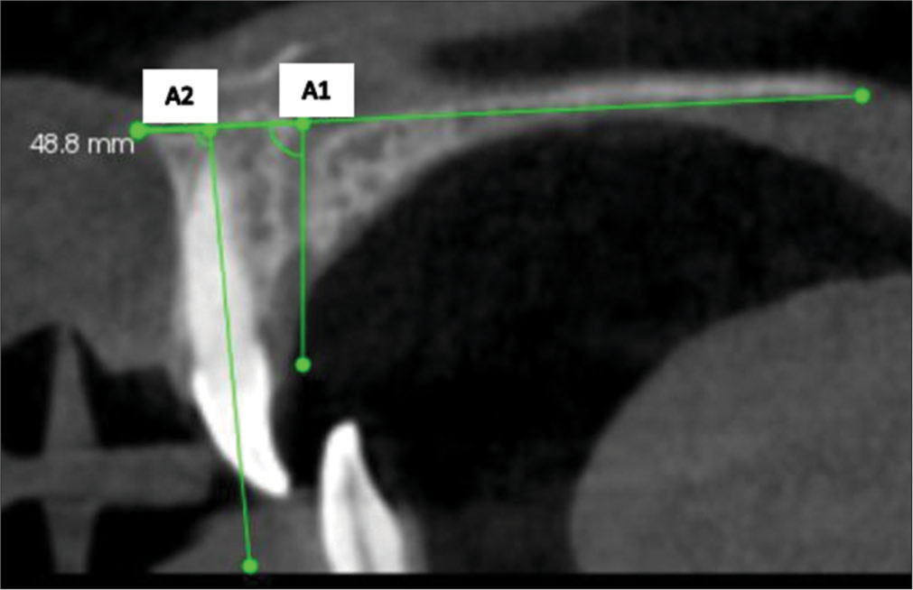 Angular measurements. A1: Angle formed by palatal plane to incisive canal A2: Angle formed by palatal plane to long axis of the tooth.