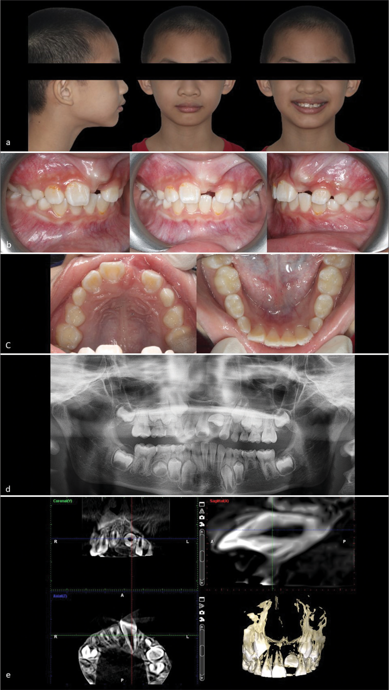 8-year 6-month-old boy who presented with an unerupted upper left central incisor. (a) Extraoral photographs (from left to right) showing a class I skeletal base with average vertical proportions at the profile view, competent lips at non-smiling frontal view, and unesthetic appearance with a clinically missing upper left central incisor at smiling frontal view. (b) Intraoral photographs (from left to right) showing right buccal, frontal, and left buccal intraoral view of a labial bulge at the unattached mucosa at the upper left central incisor region. (c) Intraoral photographs (from left to right) showing upper occlusal view depicting a mild space deficiency with an unerupted upper left central incisor and a lower occlusal view depicting mild crowding with mesiolingual rotation of the lower right lateral incisor. (d) The pre-operative dental panoramic radiograph reveals a horizontally impacted upper left central incisor, congenitally missing lower left second pre-molar and the adjacent upper incisors with open apices. (e) The pre-operative cone beam computed tomography slices illustrate a non-dilacerated impacted upper left central incisor with a short root.