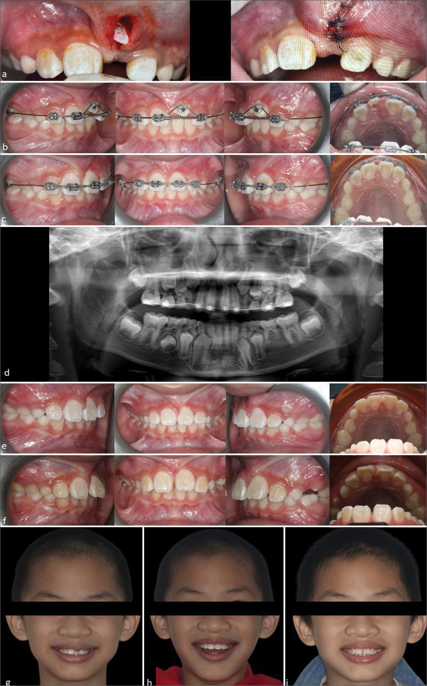 8-year 6-month-old boy who presented with an unerupted upper left central incisor. (a) Frontal photographs showing initial and final outcome of the closed surgical exposure with bonding of a modified chain attachment. (b) Mid-treatment intraoral photographs showing piggy-back mechanics of which a light 0.012-inch nickel titanium wire was attached onto the highly placed upper left central incisor over a 0.018- inch stainless steel base archwire. (c) Near-end intraoral photographs showing consolidation of the upper incisors with a power chain on a 0.018-inch stainless steel archwire. (d) Near-end treatment dental panoramic radiograph reveals successful alignment of the upper left central incisor with similar root length as the contralateral incisor. (e) Upper left central incisor in alignment with the adjacent central incisor but mild gingival discrepancy is seen at debond. (f) Vertical relapse of the upper left central incisor is seen at 6-month review. (g-i) Extraoral smiling photographs (from left to right) showing the pre-treatment, debond, and 6-month review, respectively.