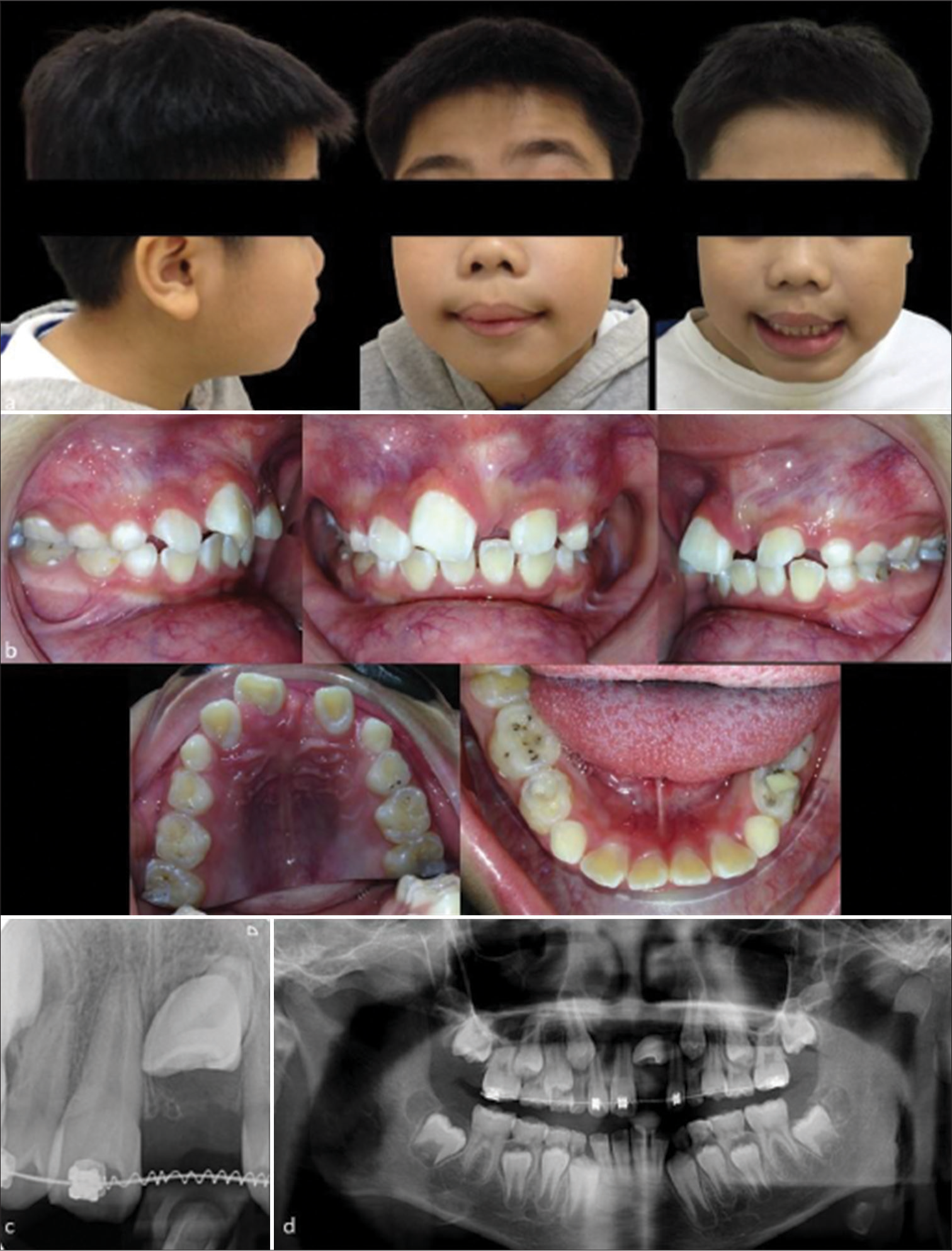 9-year 2-month-old boy who presented with a positive trauma history and impacted upper left central incisor. (a) Extraoral photographs (from left to right) showing a Class II skeletal base with average vertical proportions at the profile view, incompetent lips at rest, and a guarded smile due to unerupted upper left central incisor. (b) Intraoral photographs showing a mesiopalatal rotated upper right central incisor with a distoincisal edge fracture, unerupted upper left central incisor with a labial bulge, space deficiency due to mesial tipping of the upper left lateral incisor, and arrested caries on the deciduous molars. (c) The periapical radiograph shows a horizontal impaction of the upper left central incisor and adequate space made for its alignment. (d) The dental panoramic radiograph reveals a horizontally impacted upper left central incisor toward the midline with no root resorption of the adjacent central incisor.