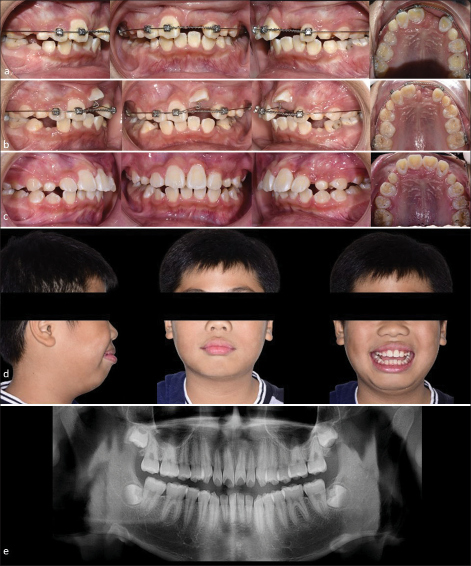 9-year 2-month-old boy who presented with a positive trauma history and impacted upper left central incisor. (a) Mid-treatment intraoral photographs showing adequate space creation of upper left central incisor with push coil on a 0.018-inch stainless steel archwire. (b) Intraoral photographs taken 11 months into treatment showing use of 0.013-inch copper-nickel-titanium wire through the gold chain of the upper left central incisor over a 0.018-inch stainless steel base archwire. (c) The upper left central incisor was successfully aligned into the arch with minimal gingival discrepancy as compared to the contralateral central incisor at debond. (d) Extraoral photographs showing protrusive soft tissues but a pleasant smile with the upper incisors aligned. (e) The dental panoramic radiograph after 3-year post-treatment reveals a minor vertical relapse of the upper left central incisor and a shorter root length compared to the adjacent central incisor.