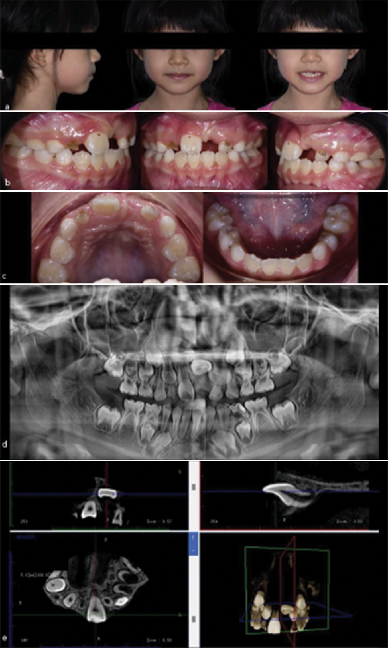 7-year 8-month-old girl presented with a horizontally impacted upper left central incisor. (a) Extraoral photographs (from left to right) depicting a skeletal Class I with average nasolabial angle at profile view, competent lips at rest and unesthetic appearance with unerupted upper left central incisor at frontal view when smiling. (b) Intraoral photographs (from left to right) showing right buccal, frontal, and left buccal intraoral view of a clinically missing upper left central incisor, poor oral hygiene, and carious upper deciduous lateral incisors. (c) Intraoral photographs (from left to right) showing upper occlusal view depicting early mixed dentition with erupted permanent right central incisor only with a mild space deficiency for the unerupted upper left central incisor. The lower occlusal view shows erupted permanent incisors with mild rotations and a large glass ionomer cement restoration at the distal of the lower left first deciduous molar. (d) The pre-operative dental panoramic radiograph depicts a horizontally impacted upper left central incisor, congenitally missing lower second pre-molars bilaterally, open apex of the contralateral upper central incisor, and severe root resorption of the upper deciduous lateral incisors indicating proximity to exfoliation time. (e) The pre-operative cone beam computed tomography slices illustrate a horizontal impaction of the upper left central incisor with a short and slightly curved root.