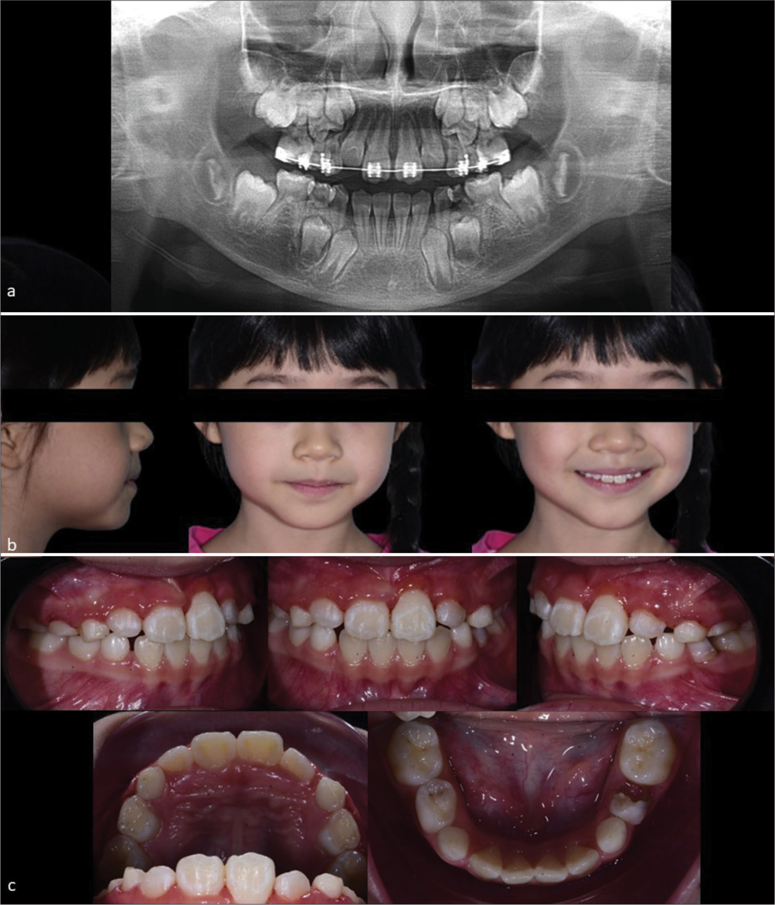 7-year 8-month-old girl presented with a horizontally impacted upper left central incisor. (a) The near-end treatment dental panoramic radiograph reveals a well-aligned upper left central incisor with good root parallelism and comparable root length as the adjacent central incisor. (b) Extraoral photographs after removing the fixed appliance illustrate a pleasant result with unchanged Class I profile, competent lips, a consonant smile arc, and average smile line. (c) Intraoral photographs at debond showing increased crown length of the upper left central incisor with gingival recession, average overbite and partially erupted upper lateral incisors. There was a dislodged restoration on the lower left deciduous first molar which was referred to the general practitioner for treatment.