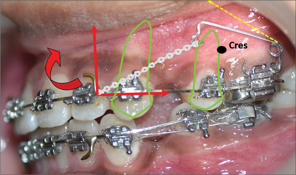 Activation of crane spring. Cres- Centre of resistance; red curved arrow- moment of anterior segment, red straight arrows-vectors of force, green matter- tooth outline depicting root position, yellow dashed arrow - activated position of the free arm