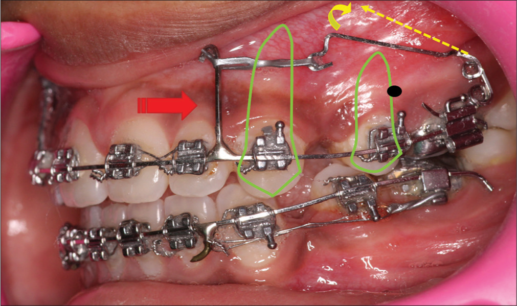 Bodily retraction with force vector passing through cres of maxillary dentition. Cres- Centre of resistance, red thick arrow - force vector, red thin arrow- occlusal plane, green matter- tooth outline depicting root position, yellow dashed arrow- activated position of free arm, yellow curved arrow- direction of movement of free arm.