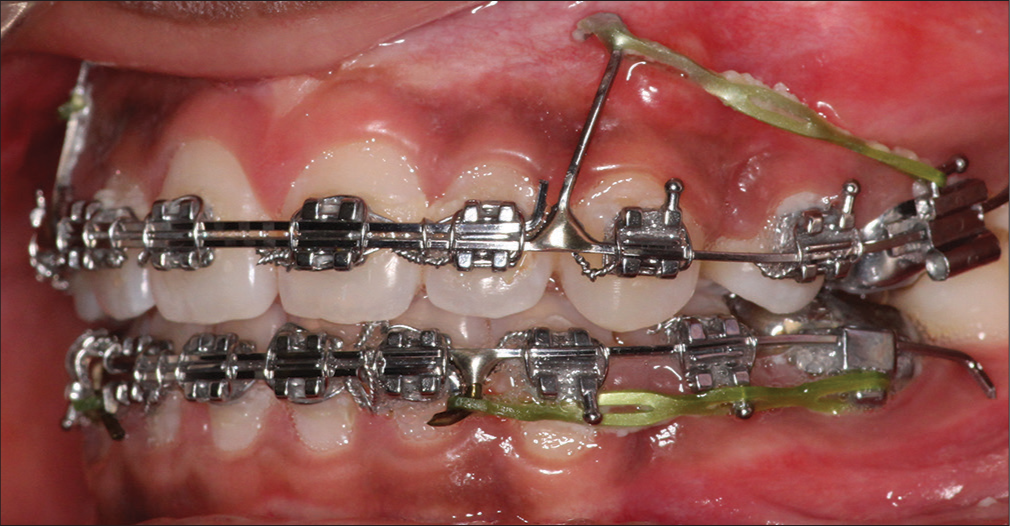 Change in force vector with anticlockwise moment of anteriors. Sectional 0.018 × 0.022inch SS wire placed in 0.018 cervical slot. Continuous 0.019 × 0.025 inch SS long posted archwire placed in 0.022 incisal slot.