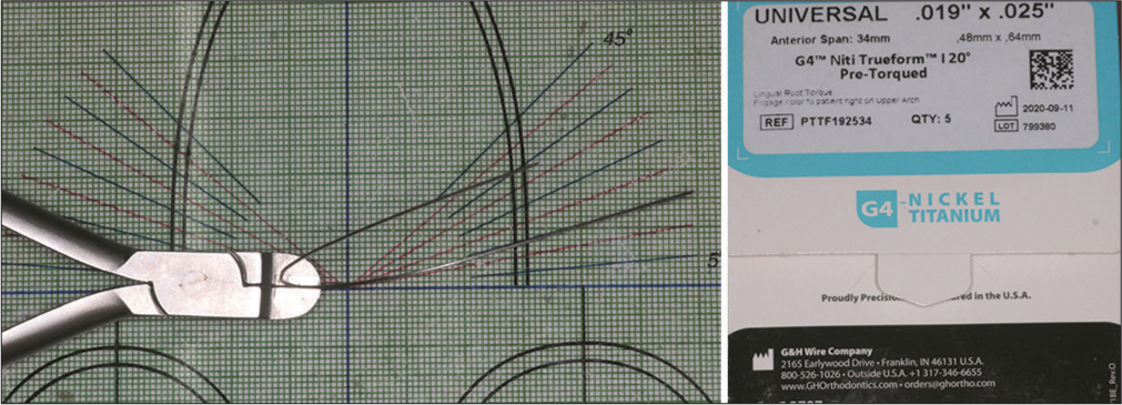 Pre-torqued NiTi (20° anterior torque).