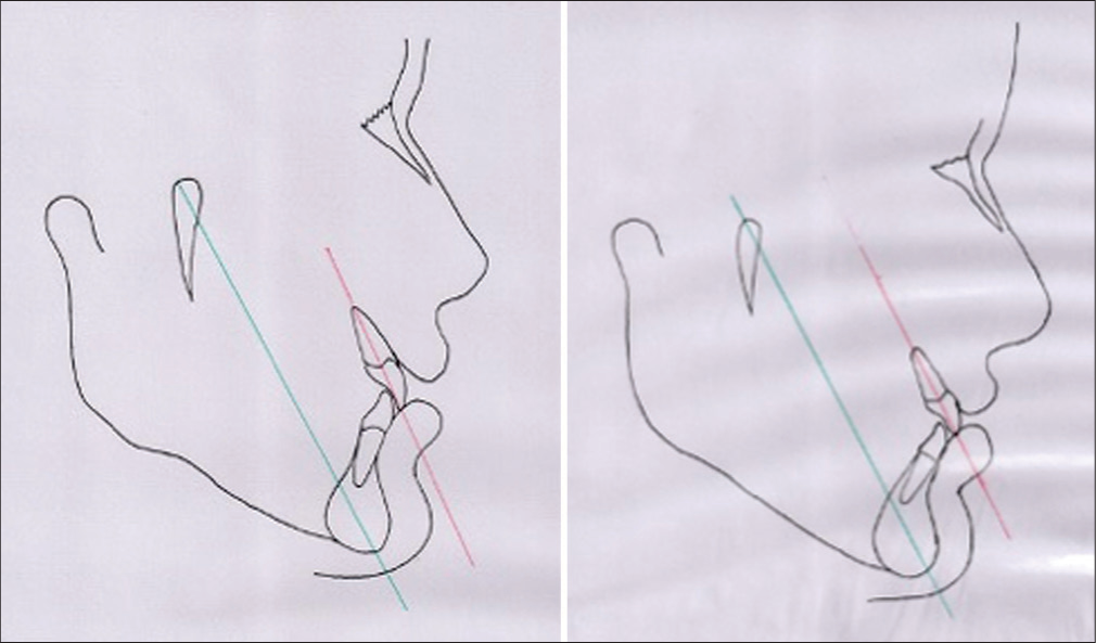 Torque correction of 3°. Redline- long axis of the upper incisor green line - facial axis [Ptm(ptrygomaxillary fissure) to Gnathion].