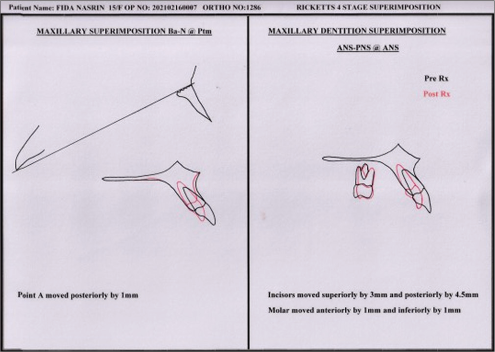 Superimposition. ANS-PNS: Anterior nasal spine -posterior nasal spine, Rx: Treatment