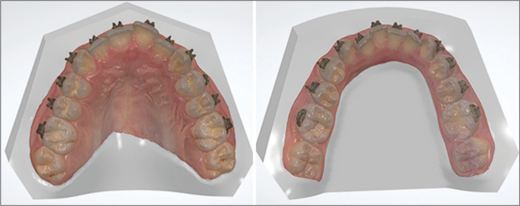 Bracketed intraoral scan images.