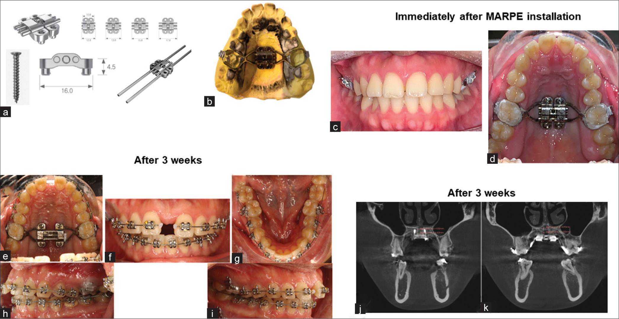 (a) MARPE appliance, and (b) MARPE design, (c and d) immediately after MARPE installation, (e-i) three weeks after MARPE installation, and (j and k) cone beam computed tomography (CBCT) scans three weeks after MARPE installation; MARPE: miniscrew-assisted rapid palatal expansion.