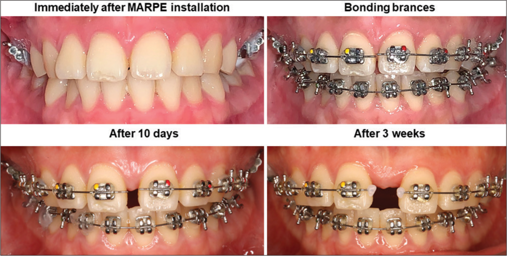 MARPE: miniscrew-assisted rapid palatal expansion.