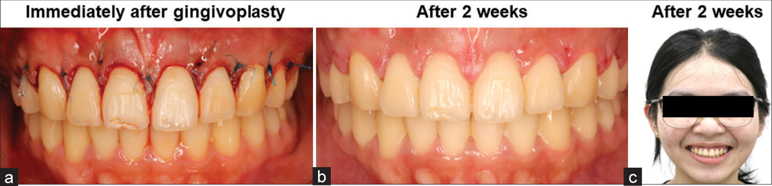 (a) Immediately after gingivoplasty, and (b,c) two weeks after gingivoplasty.